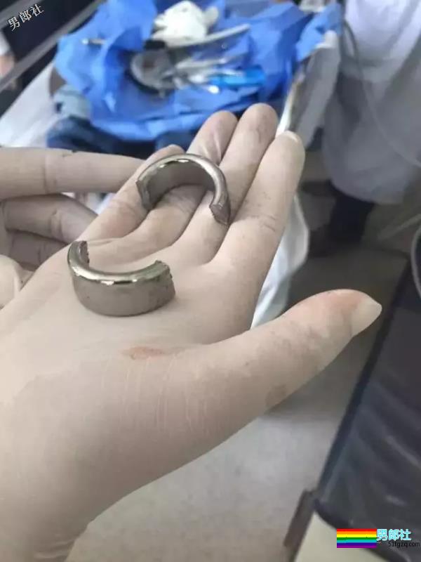 山东大学生弟弟套铁环肿胀巨大！求助消防员才取下 - 51虹马