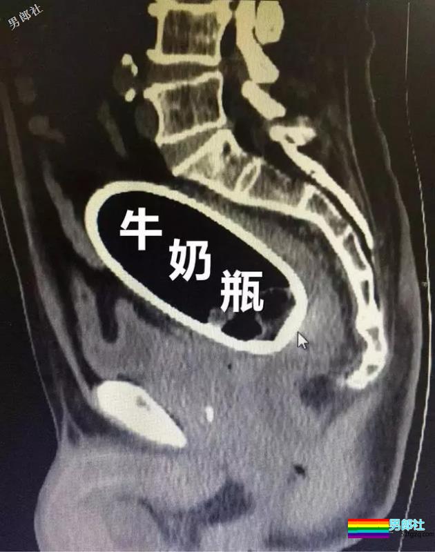 男子PP里塞牛奶瓶,取不出来了!-51虹马