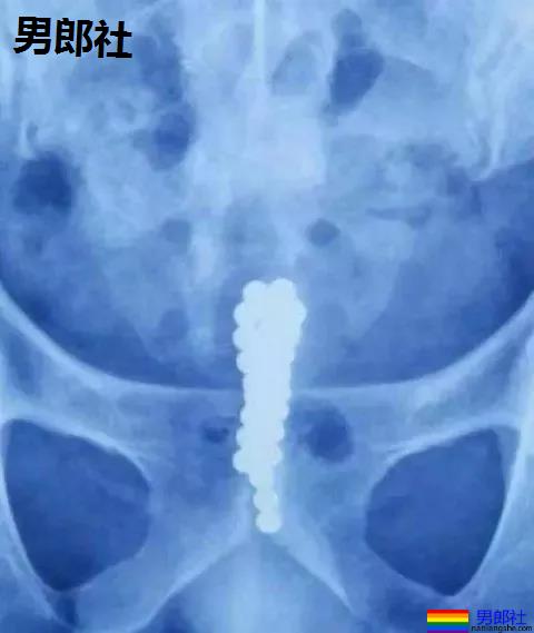 西安一男子往尿道塞了28颗巴克球…现在的同志真会玩!-51虹马