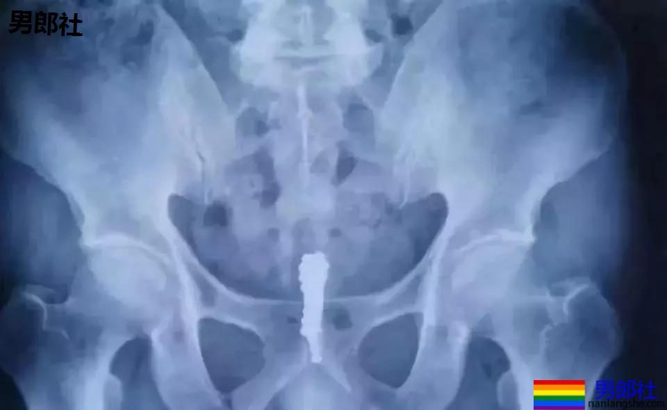 西安一男子往尿道塞了28颗巴克球…现在的同志真会玩! - 51虹马 西安一男子往尿道塞了28颗巴克球…现在的同志真会玩! - 51虹马