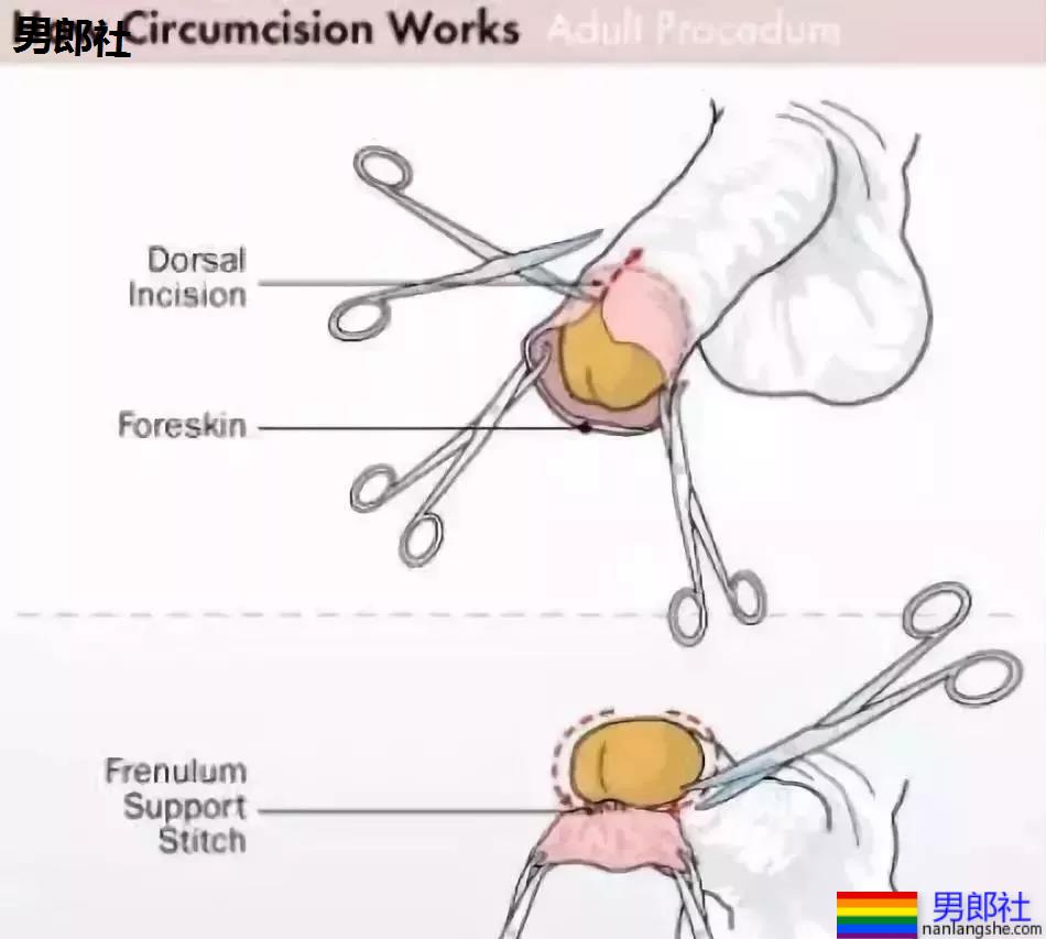 医院里割下的包皮去哪了？ - 51虹马