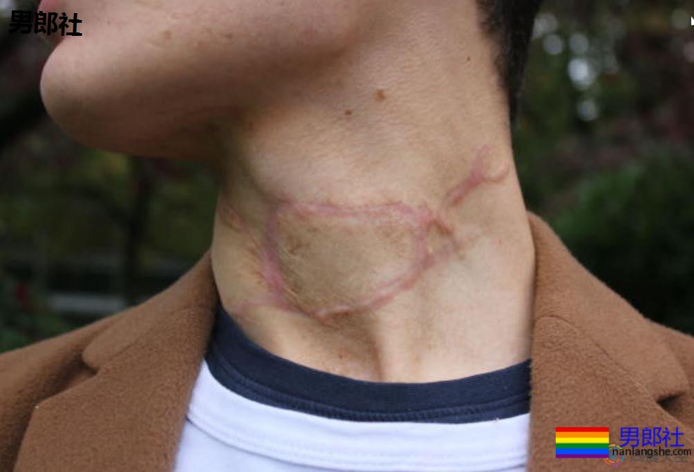 17岁少年被父亲割喉就因你是同性恋? - 51虹马 17岁少年被父亲割喉就因你是同性恋? - 51虹马