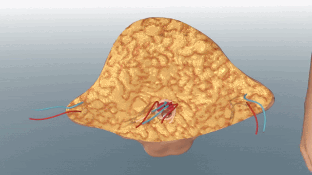 全球首例最完整丁丁移植手术:敏感度高,功能正常 - 51虹马 全球首例最完整丁丁移植手术:敏感度高,功能正常 - 51虹马