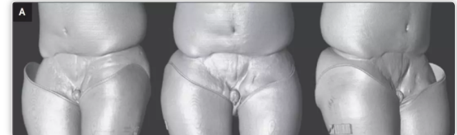 全球首例最完整丁丁移植手术:敏感度高,功能正常 - 51虹马 全球首例最完整丁丁移植手术:敏感度高,功能正常 - 51虹马