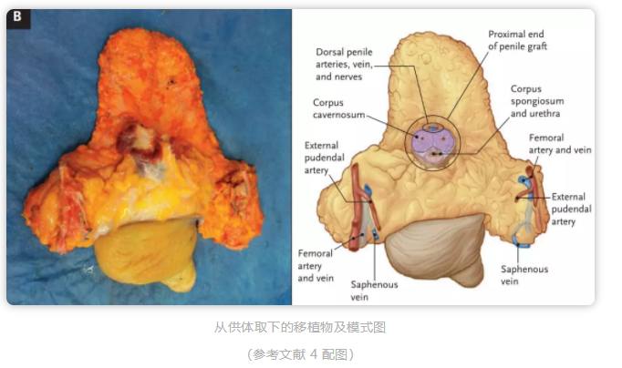 全球首例最完整丁丁移植手术:敏感度高,功能正常 - 51虹马 全球首例最完整丁丁移植手术:敏感度高,功能正常 - 51虹马