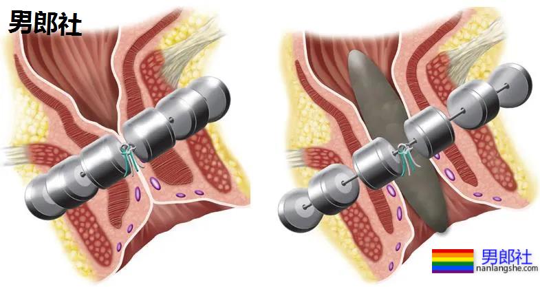 长期做0真的会漏S吗?-51虹马