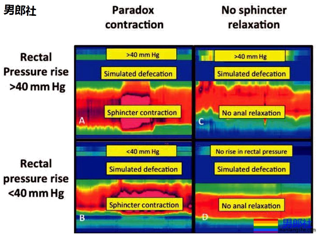 长期做0真的会漏S吗？ - 51虹马
