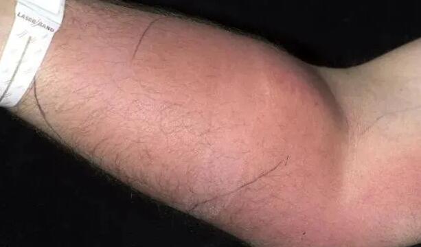 奇葩！国外一男子为治背痛将精液注入自己的手臂-51虹马