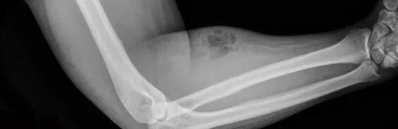 奇葩！国外一男子为治背痛将精液注入自己的手臂 - 51虹马