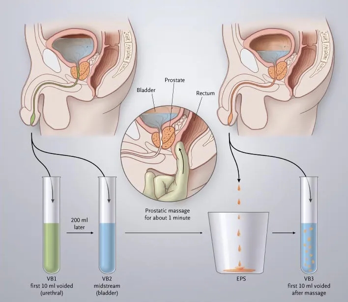 前列腺发炎,还可以尝试边缘控制吗? - 51虹马 前列腺发炎,还可以尝试边缘控制吗? - 51虹马