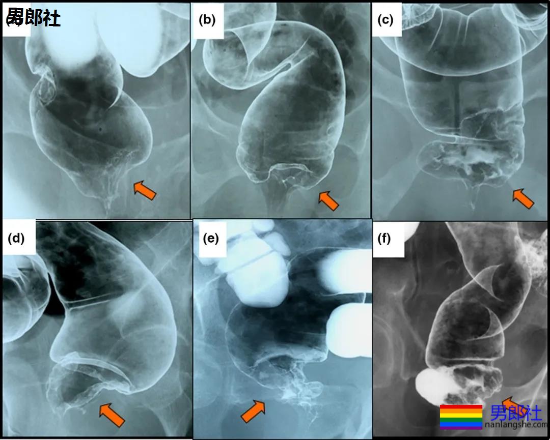 菊花长疣物，需不需要动手术？ - 51虹马