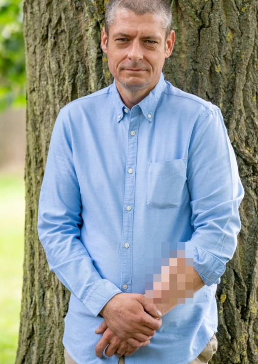 全球首位前臂长出生殖器的男人 背后原因令人意想不到 - 51虹马