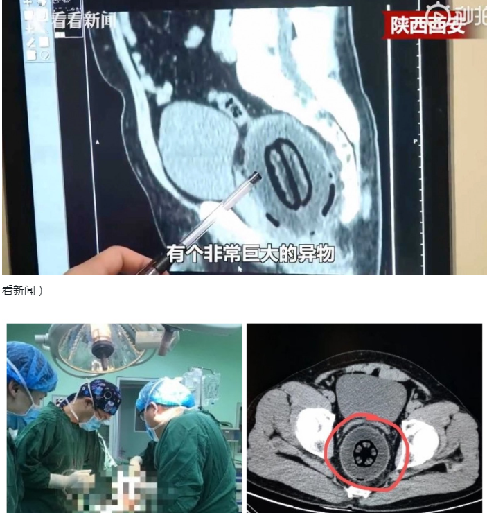 超狂男子腹痛6小时羞求医，直肠惊现20公分大木瓜：不小心塞进去的... - 51虹马