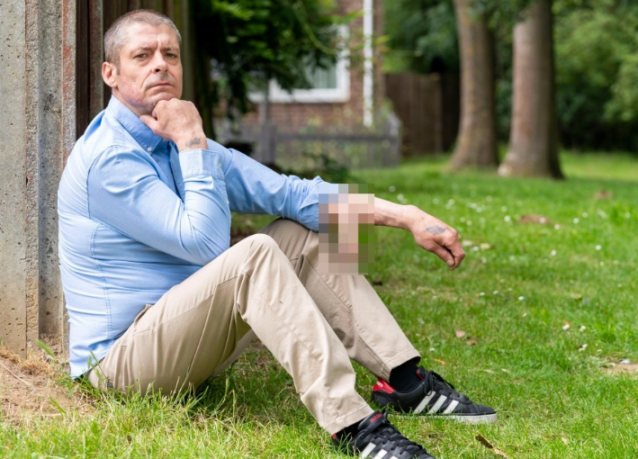 全球首位前臂长出生殖器的男人 背后原因令人意想不到-51虹马