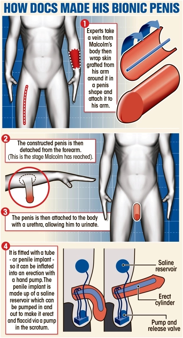 全球首位前臂长出生殖器的男人 背后原因令人意想不到 - 51虹马