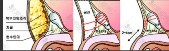 亲身经历阴茎增大手术, 粗重要还是长重要 - 51虹马 亲身经历阴茎增大手术, 粗重要还是长重要 - 51虹马