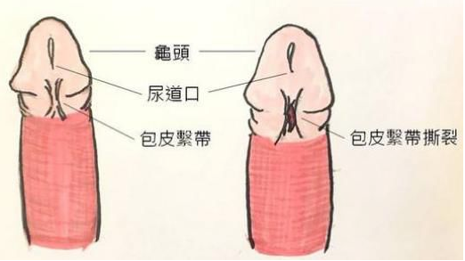 关于「龟头」的10个真相 - 51虹马 关于「龟头」的10个真相 - 51虹马