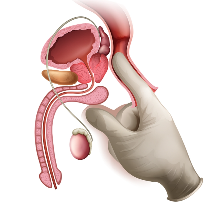 黄金 10 分钟！ 提早做到「这件事」可降低前列腺癌死亡率 - 51虹马