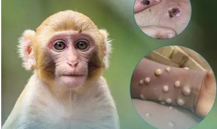 越南首例猴痘死亡病例 男子同时患有HIV-51虹马